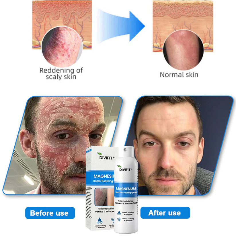 Divifit® Magnesium Herbal Psoriasis Spray
